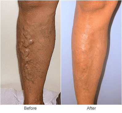Treatment & Causes of Varicose Veins
