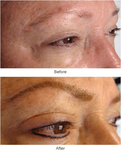 Eyeliner & Eyebrow Tattooing Before & After Photo