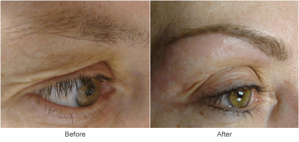 Eyeliner & Eyebrow Tattooing: Before & After Permanement Cosmetics