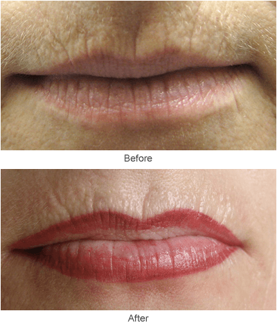 Permanement Lip Liner Tattooing Before & After